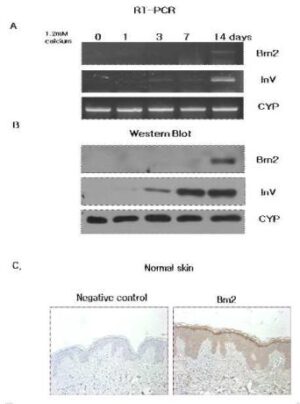 편평태선 진단용 마커로서의 Ｂｒｎ２의 용도