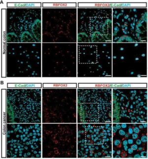 알비폭스 2 단백질 항체를 유효성분으로 함유하는 소화기계 암 진단용 조성물 및 키트